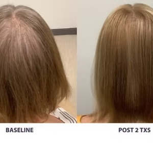 3 Sessions AlmaTED- 44% OFF!