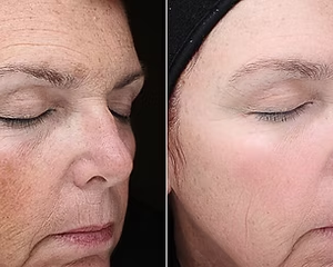 VI PEEL-Chemical Peel (23% OFF!)